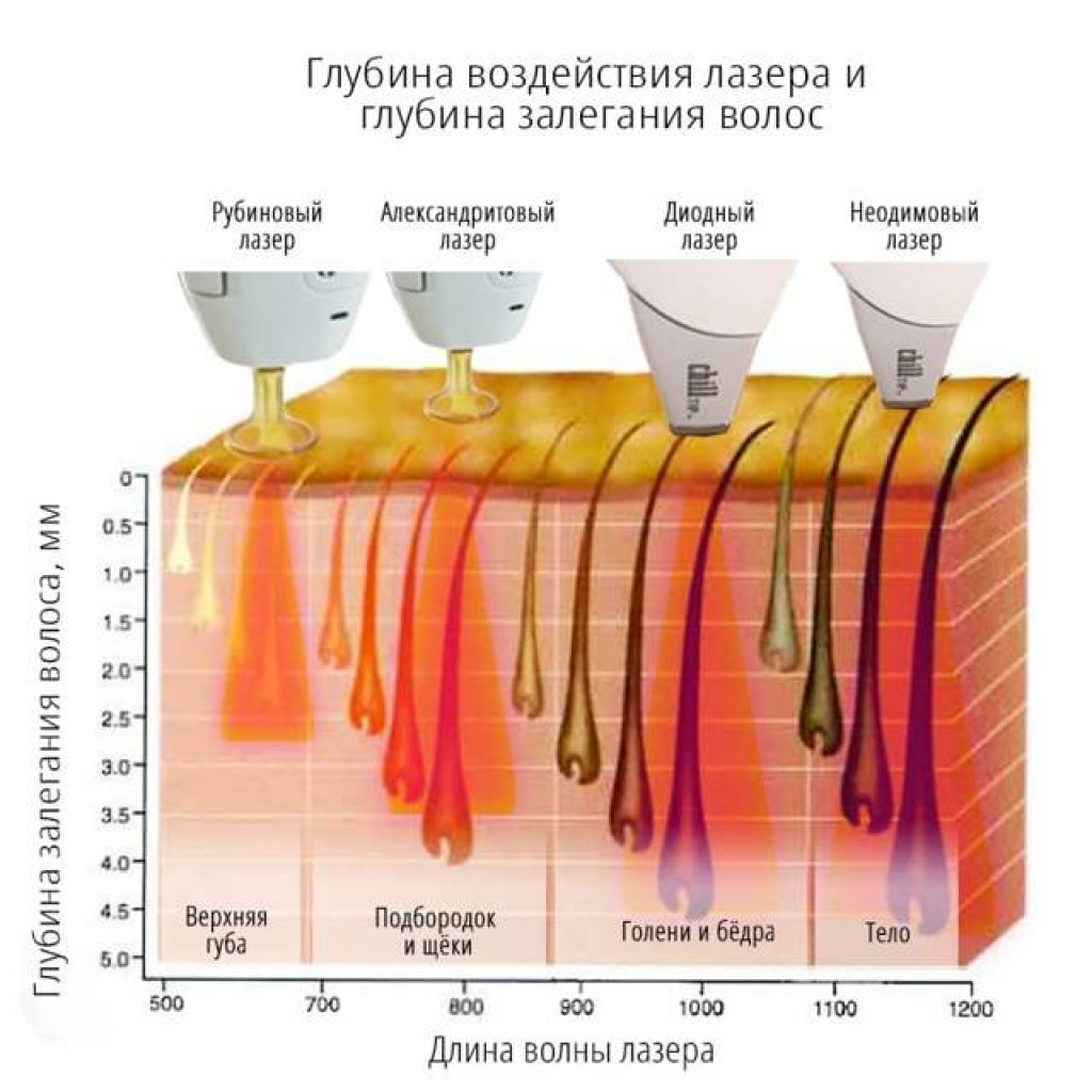 Лазерная эпиляция: Как избавится от волос?